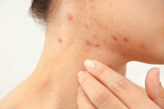 What Is Causing Your Adult Acne?