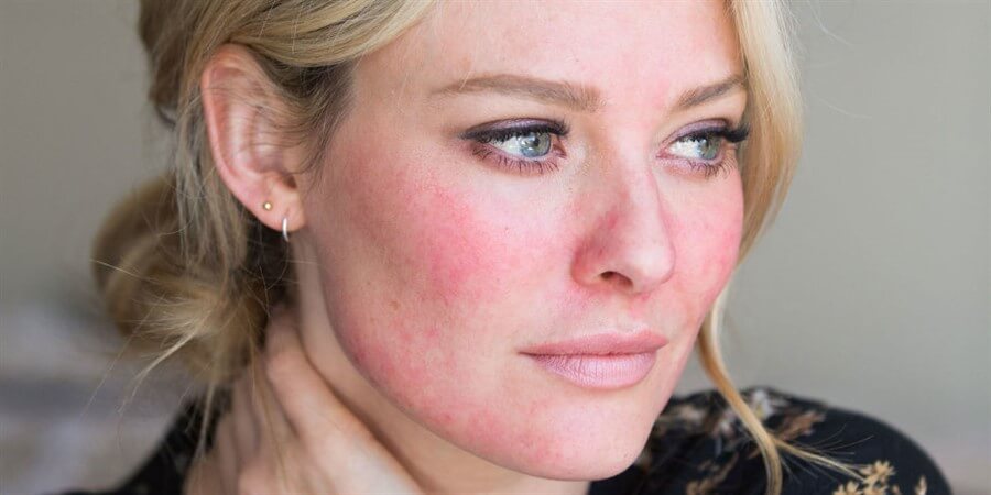 Defining Rosacea | Understanding The Complex Terminology