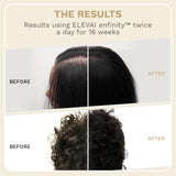 Elevai Root Renewal System™