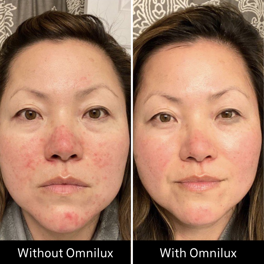 Omnilux Contour FACE