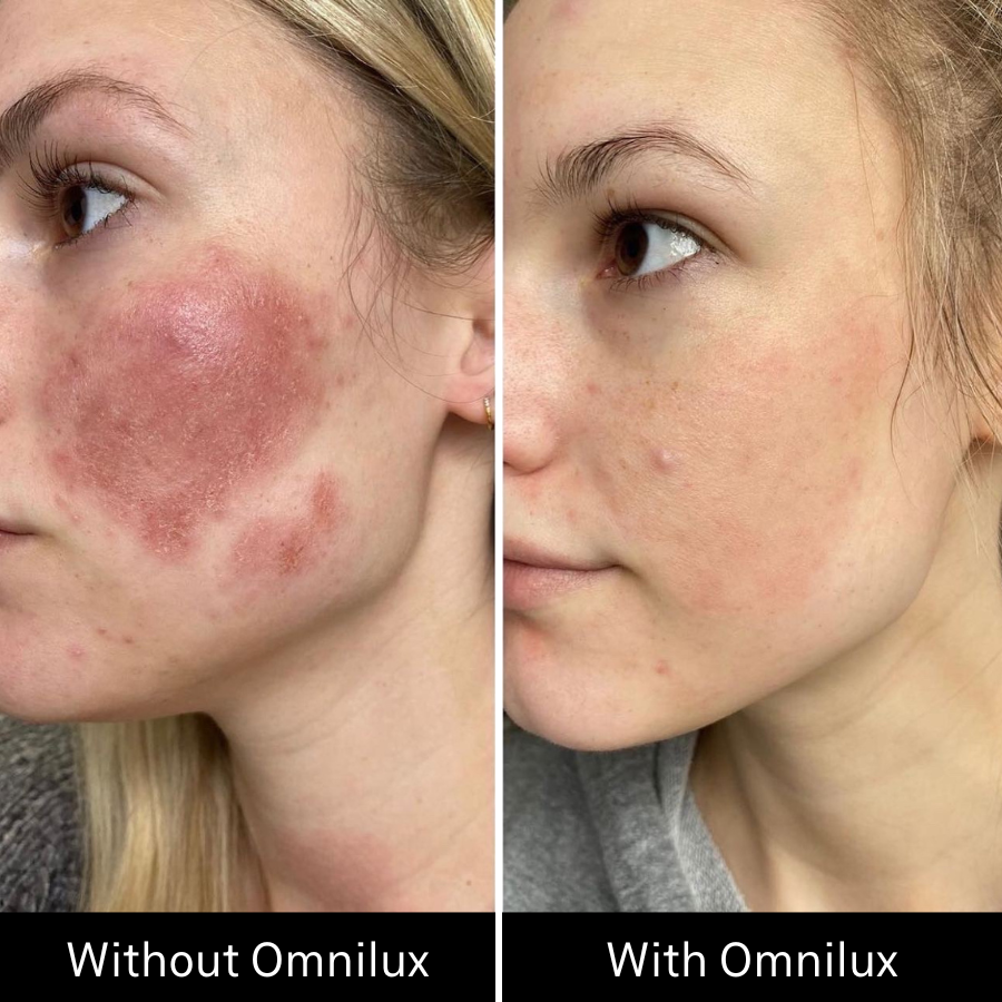 Omnilux Contour FACE