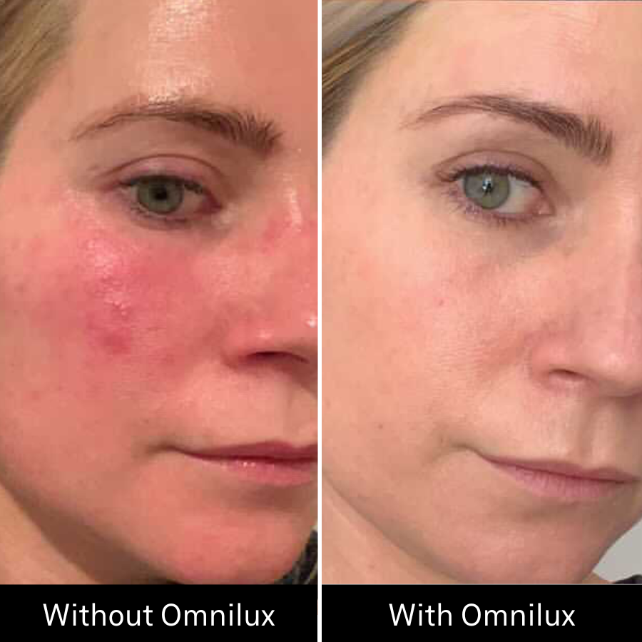 Omnilux Contour FACE