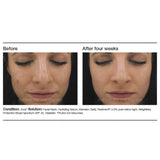 PCA Skin Intensive Clarity Treatment : 0.5% Pure Retinol & Salicylic Acid